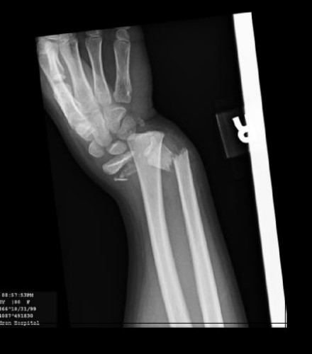 broken-wrist [1600x1200].jpg